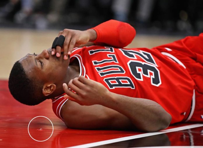 Kris Dunn concussion Bulls